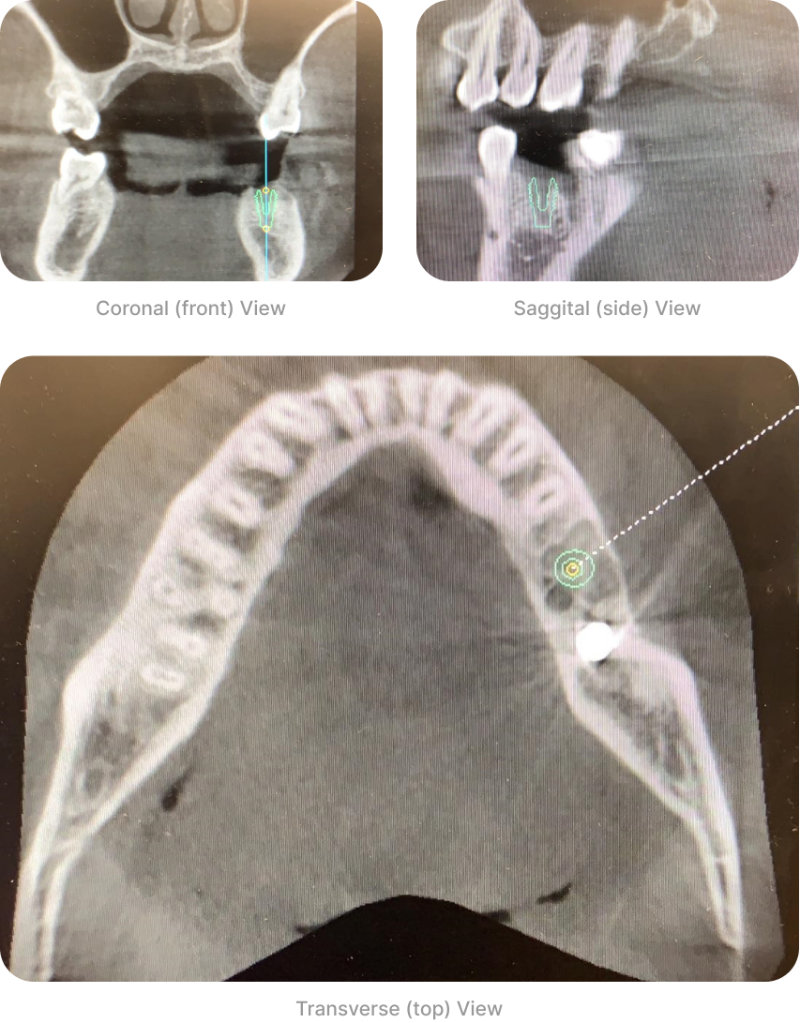 Dental-Implant-Treatment-Planning-Part-3