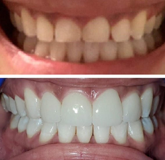 Dental Veneer Case 1
