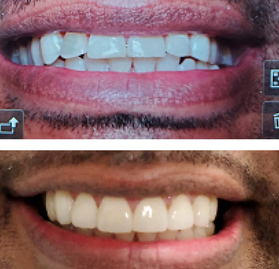 Dental Veneer Case 2