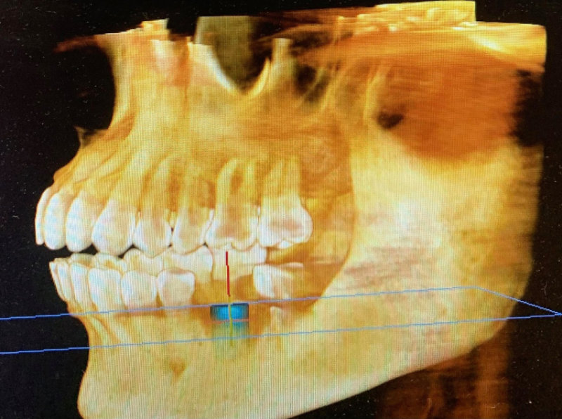 Implant-Restoration