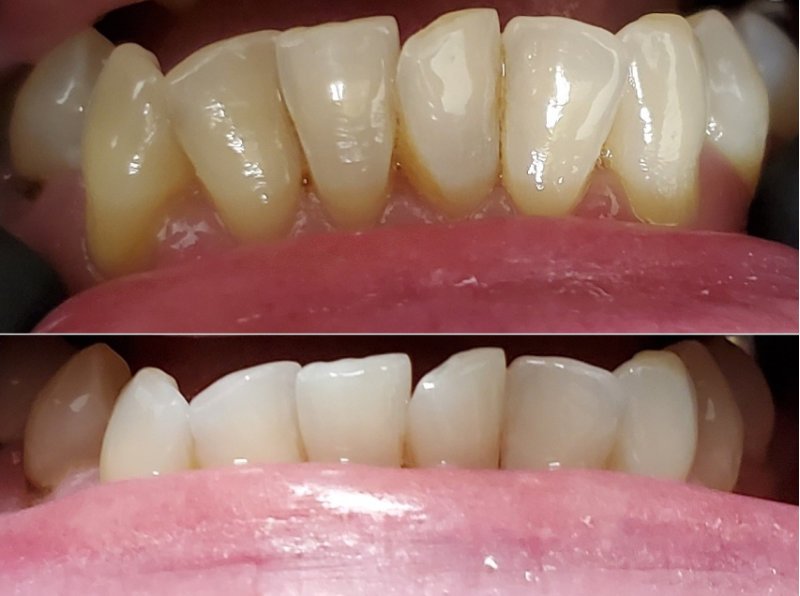 Teeth Whitening Case 2