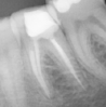 Root Canal